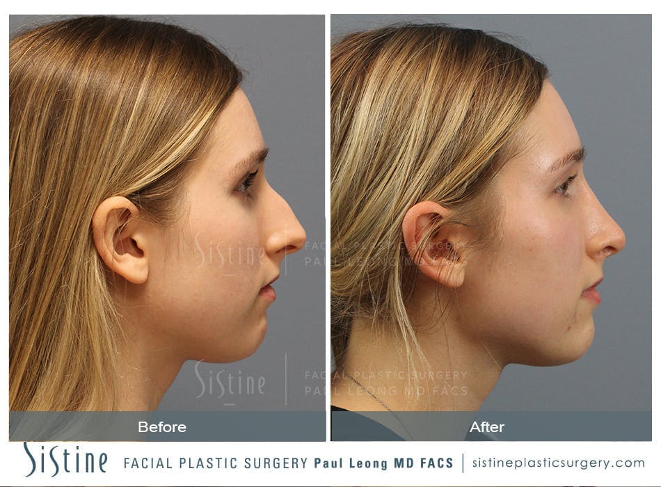 Rhinoplasty Before and After | Leong Facial Plastic Surgery