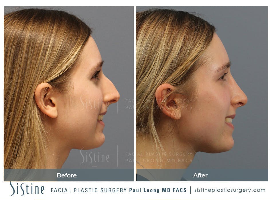 Rhinoplasty Before and After | Leong Facial Plastic Surgery