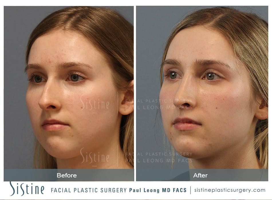 Rhinoplasty Before and After | Leong Facial Plastic Surgery