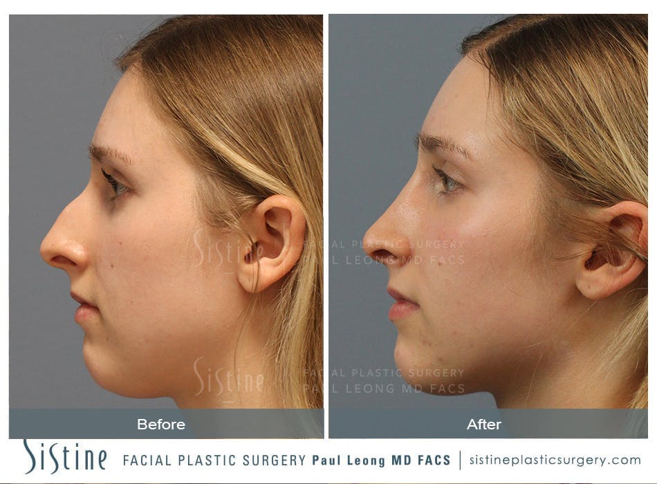 Rhinoplasty Before and After | Leong Facial Plastic Surgery