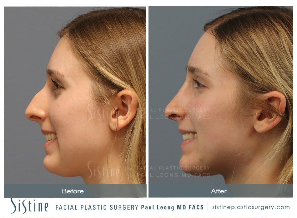 Rhinoplasty Before and After | Leong Facial Plastic Surgery