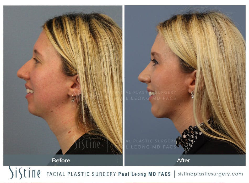 Rhinoplasty Before and After | Leong Facial Plastic Surgery