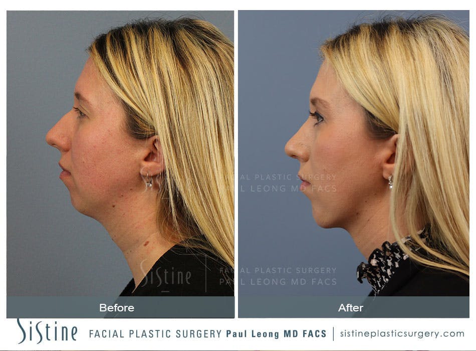 Rhinoplasty Before and After | Leong Facial Plastic Surgery