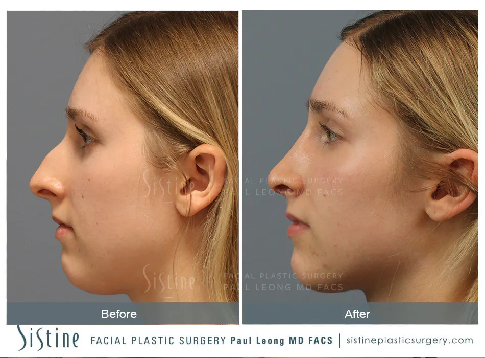 Female Rhinoplasty - Patient Preoperative View | Dr. Paul Leong