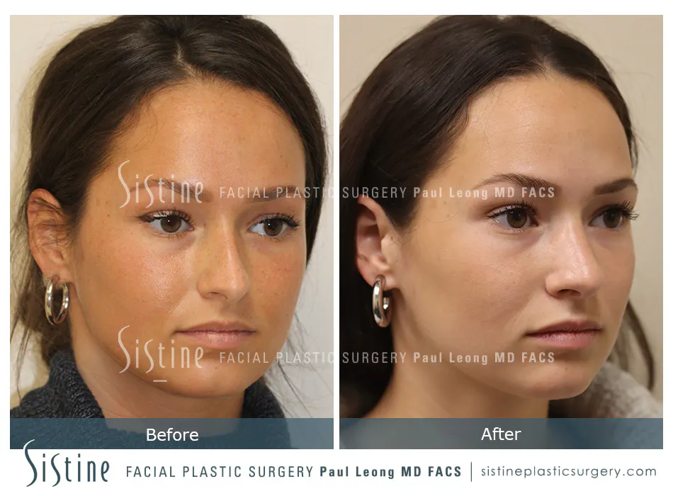 Rhinoplasty Before and After | Leong Facial Plastic Surgery