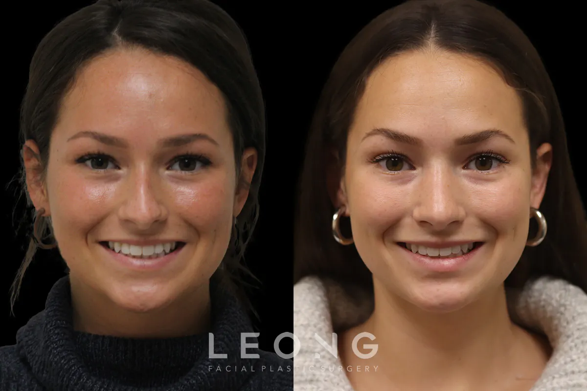 Rhinoplasty Before and After | Leong Facial Plastic Surgery