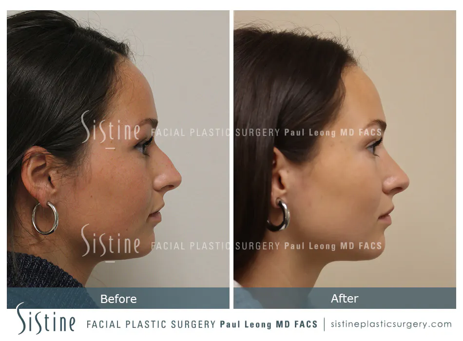 Rhinoplasty Before and After | Leong Facial Plastic Surgery