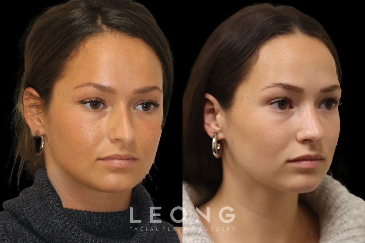 Rhinoplasty Before and After | Leong Facial Plastic Surgery