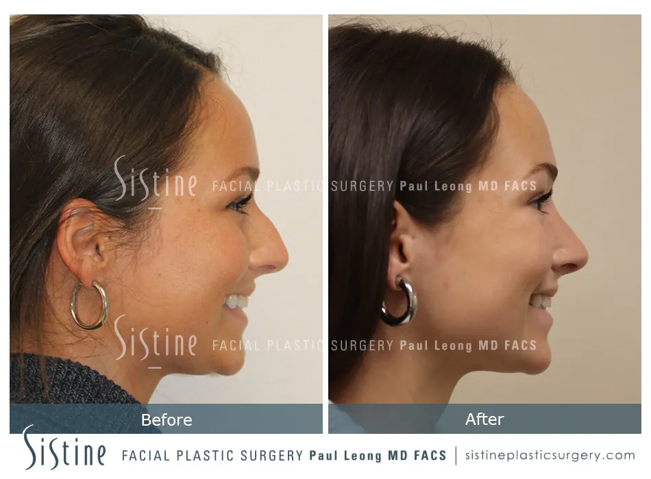 Rhinoplasty Before and After | Leong Facial Plastic Surgery