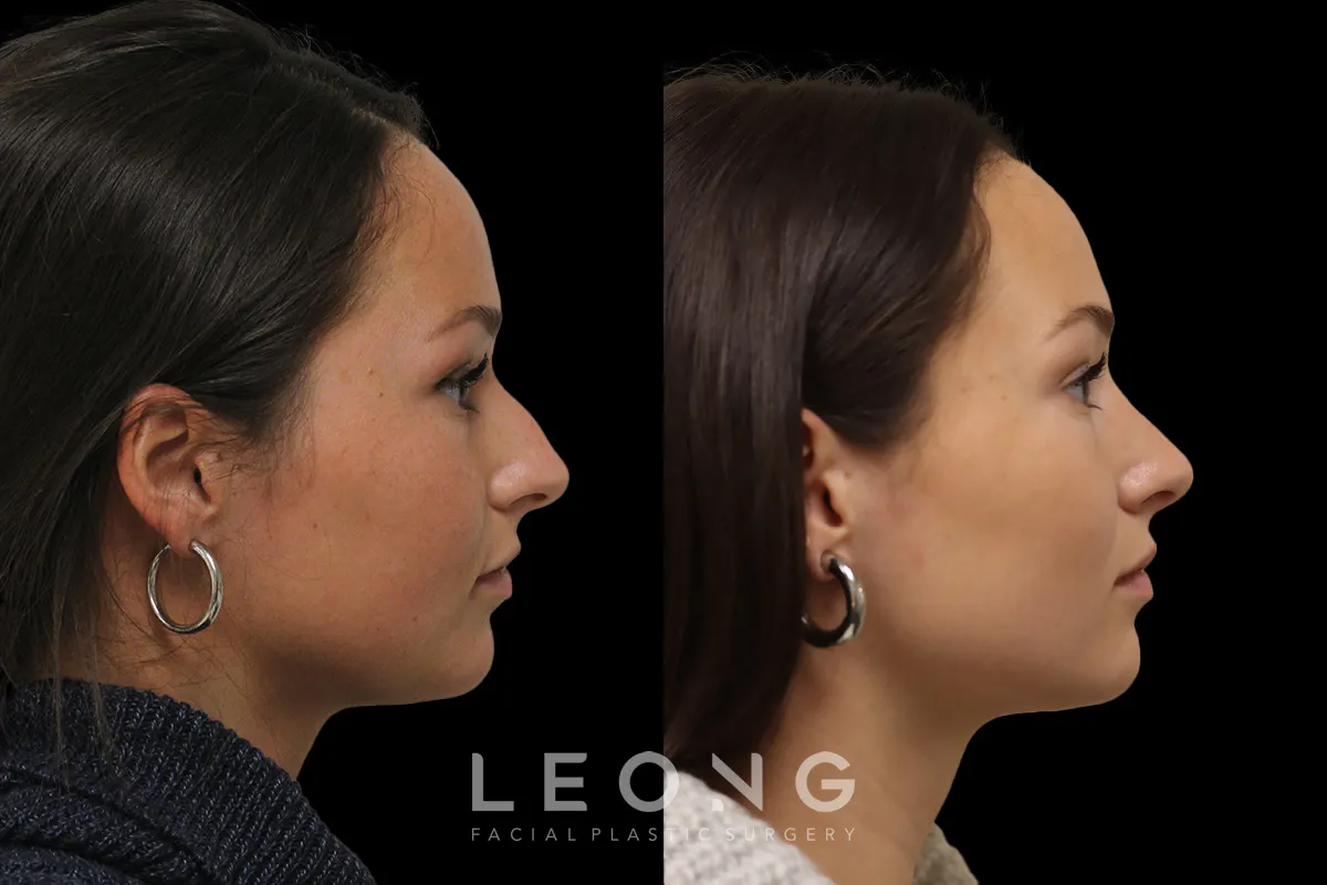Rhinoplasty Before and After | Leong Facial Plastic Surgery