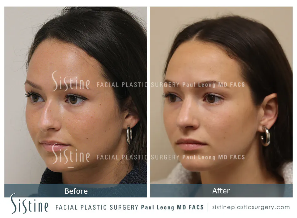 Rhinoplasty Before and After | Leong Facial Plastic Surgery