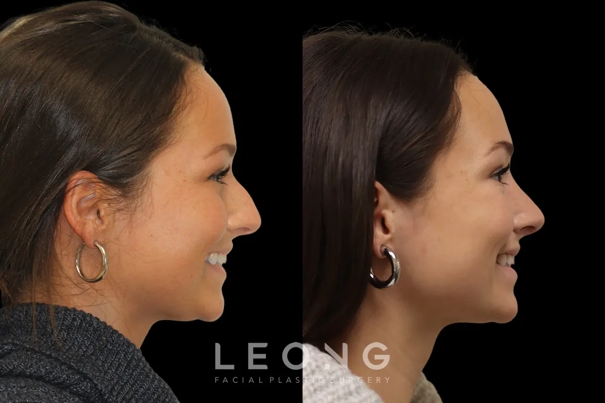 Rhinoplasty Before and After | Leong Facial Plastic Surgery