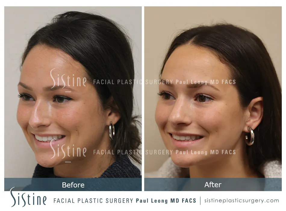 Rhinoplasty Before and After | Leong Facial Plastic Surgery