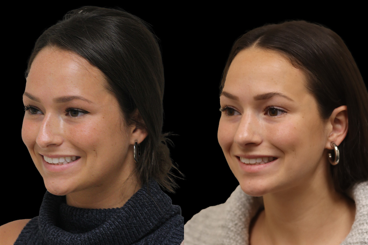 Rhinoplasty Before and After | Leong Facial Plastic Surgery