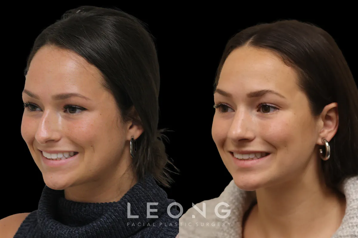 Rhinoplasty Before and After | Leong Facial Plastic Surgery