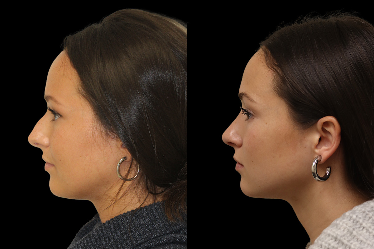 Rhinoplasty Before and After | Leong Facial Plastic Surgery