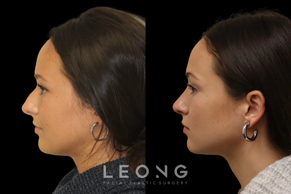 Rhinoplasty Before and After | Leong Facial Plastic Surgery