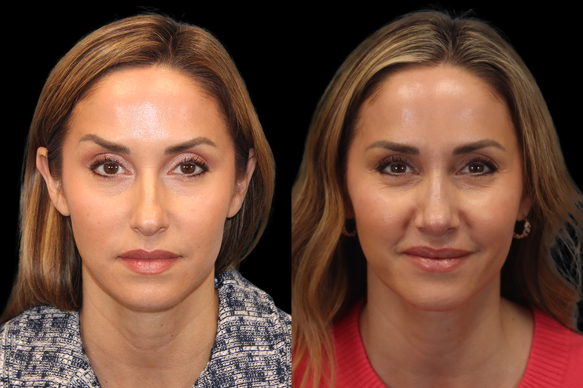 Rhinoplasty Before and After | Leong Facial Plastic Surgery