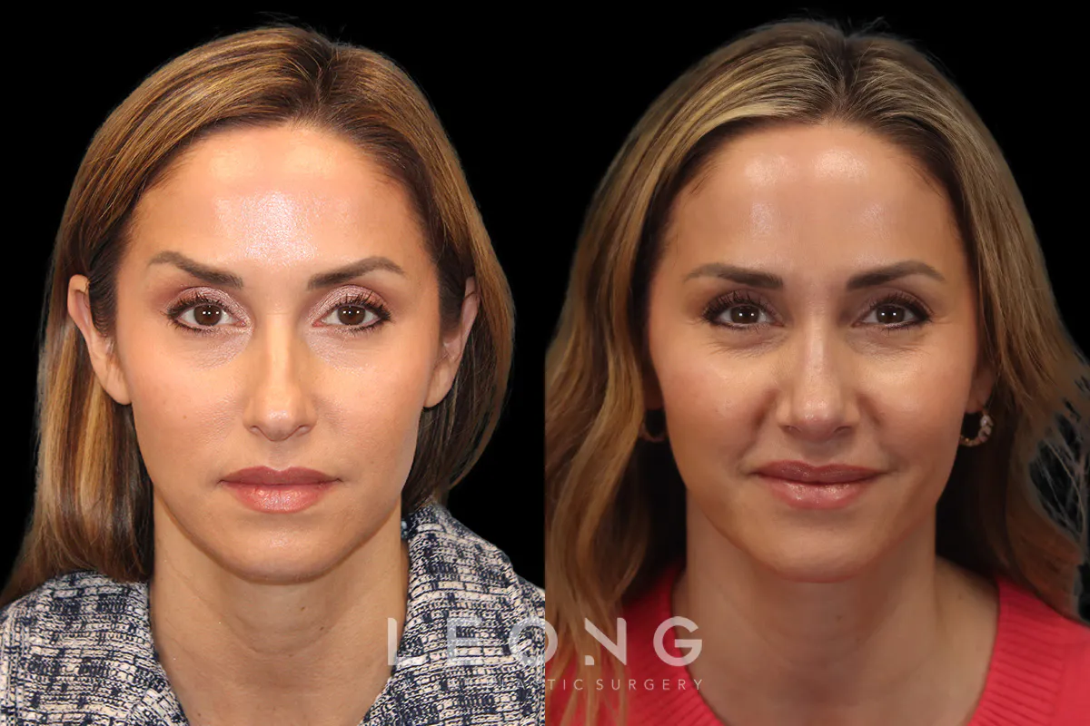 Rhinoplasty Before and After | Leong Facial Plastic Surgery