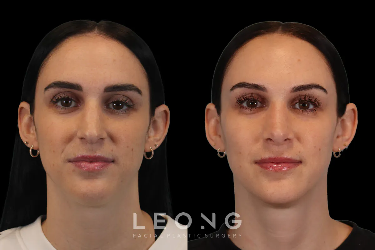 Rhinoplasty Before and After | Leong Facial Plastic Surgery