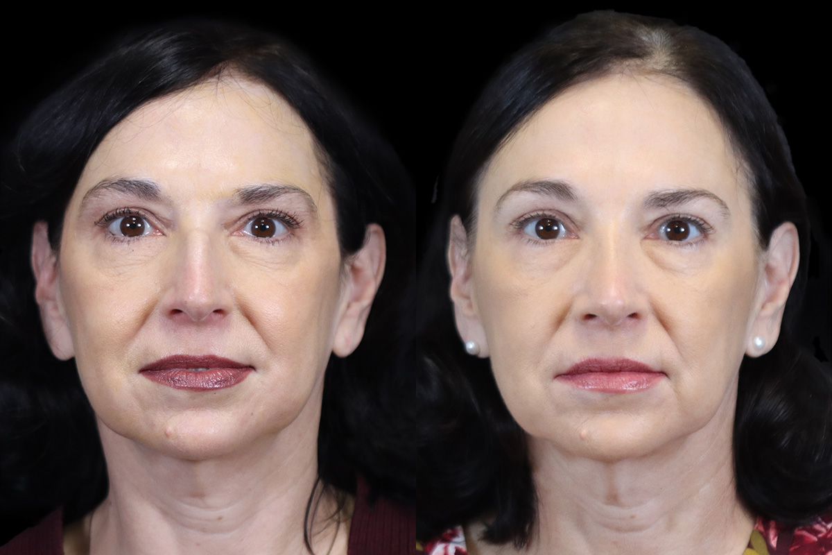 Rhinoplasty Before and After | Leong Facial Plastic Surgery