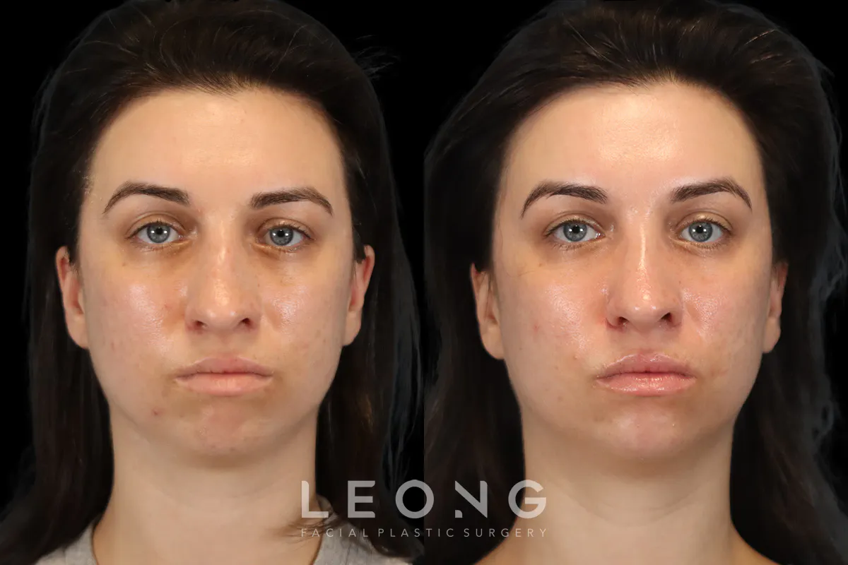 Rhinoplasty Before and After | Leong Facial Plastic Surgery