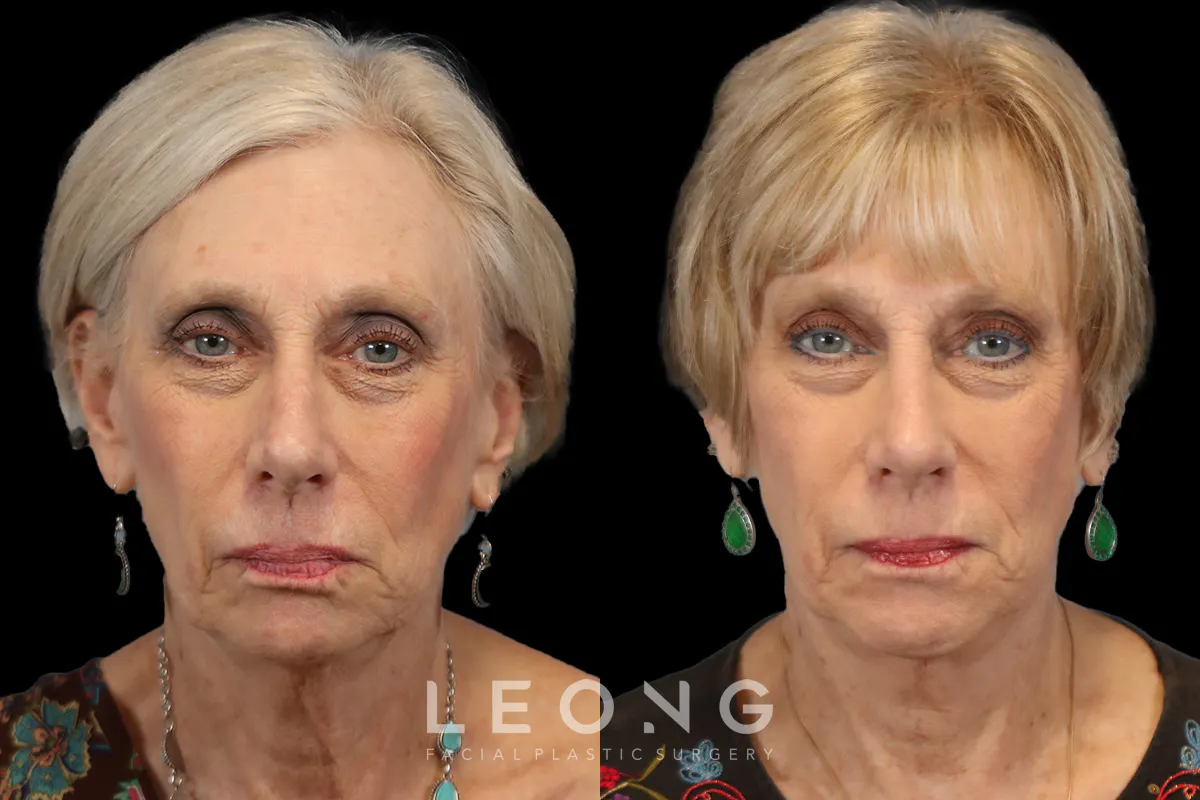 Rhinoplasty Before and After | Leong Facial Plastic Surgery