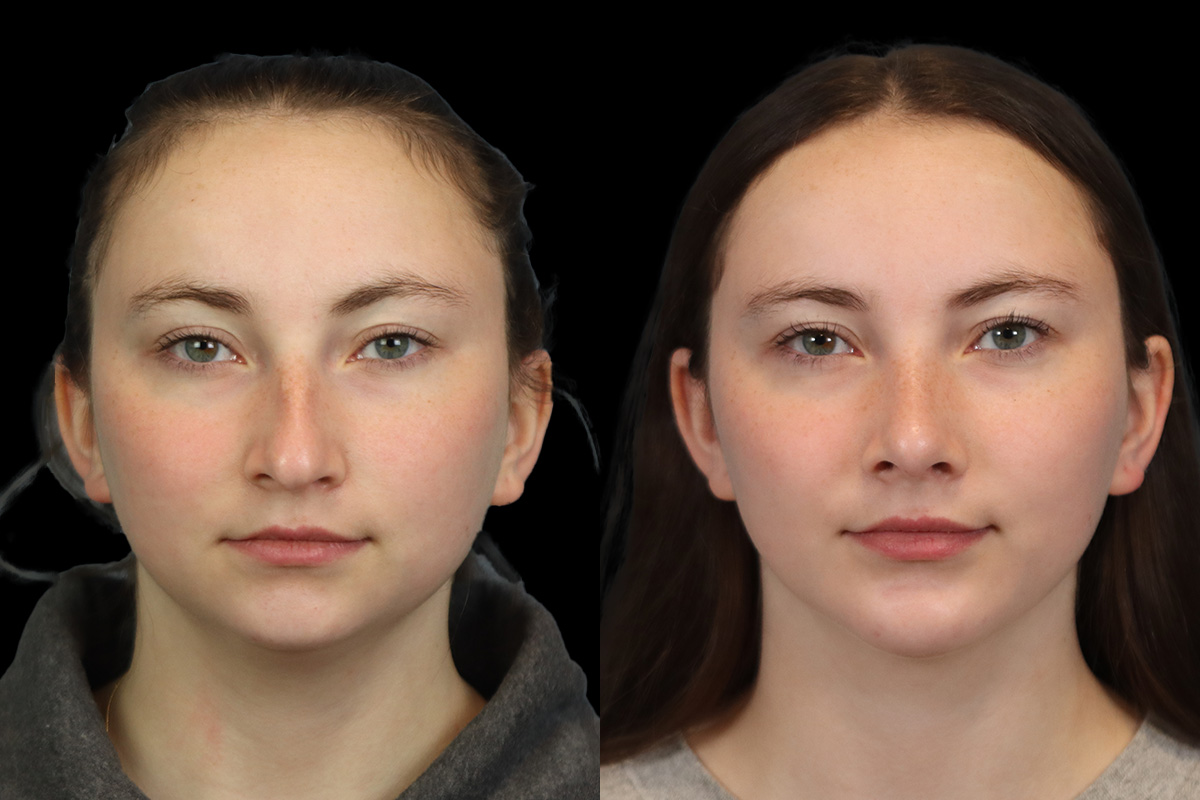 Rhinoplasty Before and After | Leong Facial Plastic Surgery