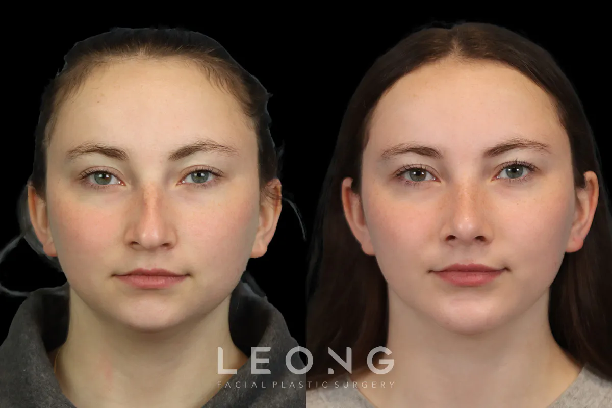 Rhinoplasty Before and After | Leong Facial Plastic Surgery