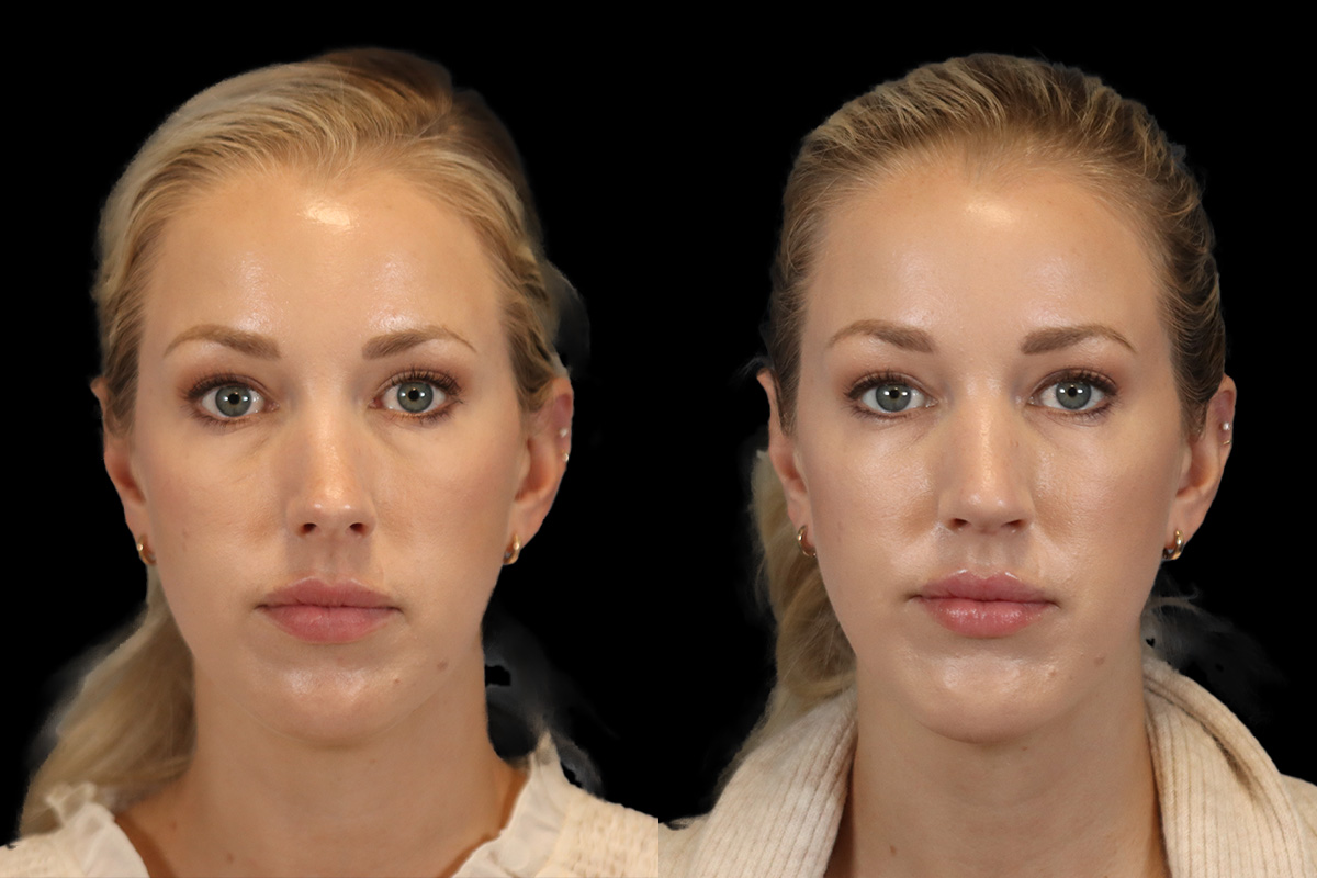 Rhinoplasty Before and After | Leong Facial Plastic Surgery