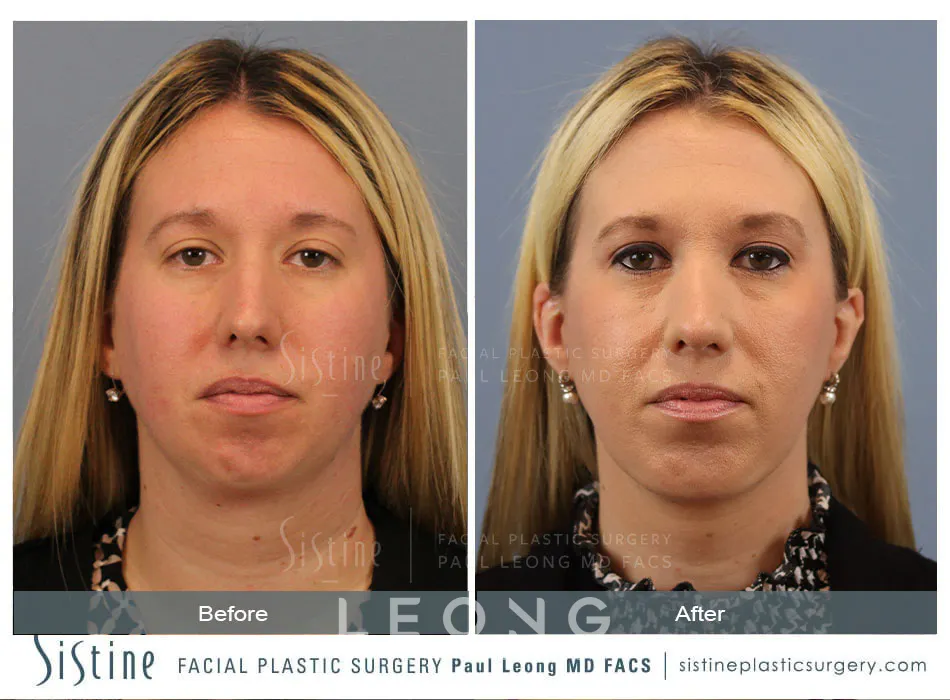 Rhinoplasty Before and After | Leong Facial Plastic Surgery