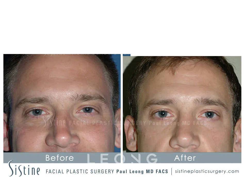 Rhinoplasty Before and After | Leong Facial Plastic Surgery