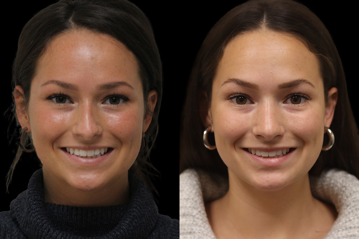 Restylane Dermal Fillers for Tear Trough - Before Treatment | Dr. Paul Leong, Pittsburgh PA