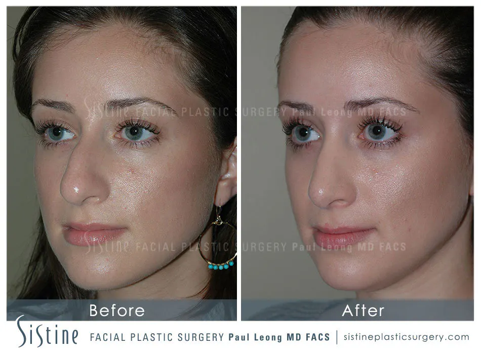 Rhinoplasty Before and After | Leong Facial Plastic Surgery