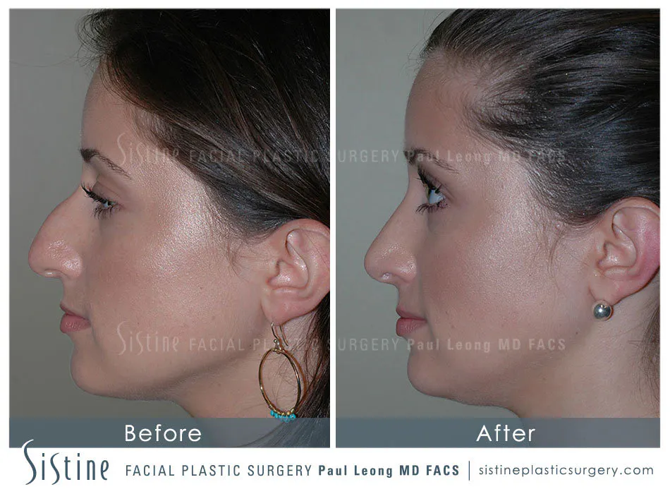 Rhinoplasty Before and After | Leong Facial Plastic Surgery