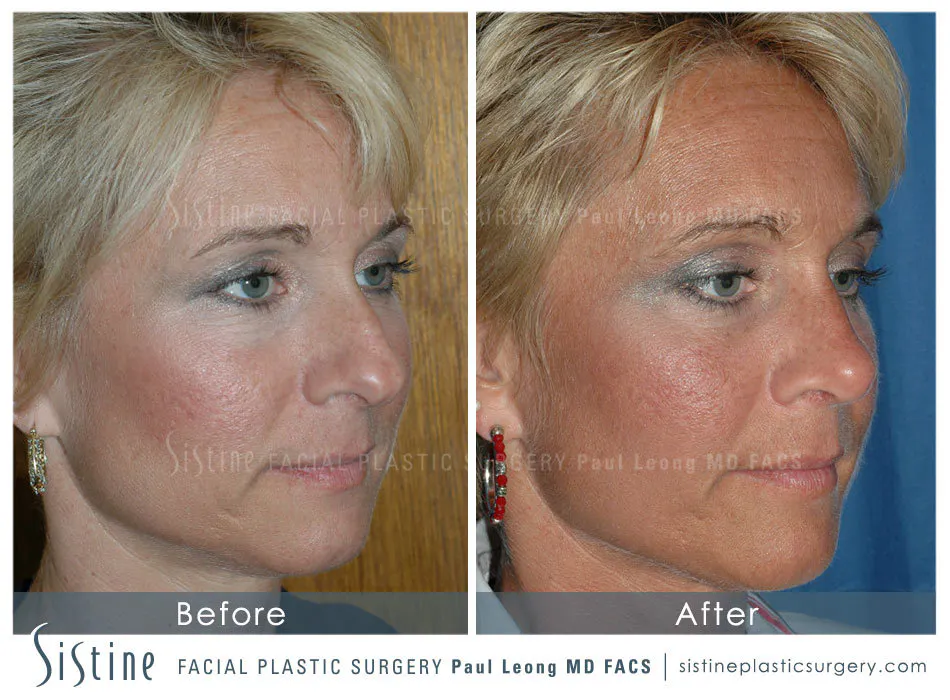Rhinoplasty Before and After | Leong Facial Plastic Surgery