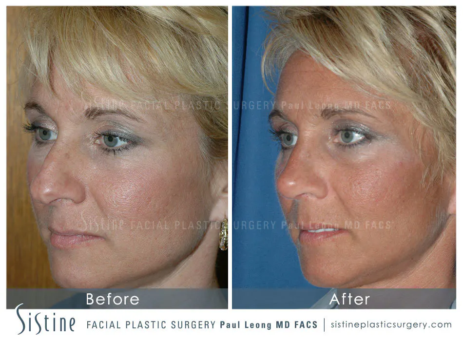 Rhinoplasty Before and After | Leong Facial Plastic Surgery