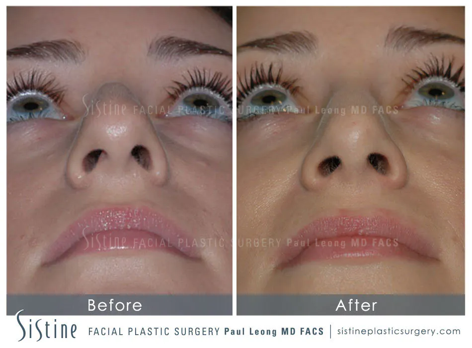 Nose Jobs Before and After in Pittsburgh - Basal View Preoperative | Dr. Paul Leong
