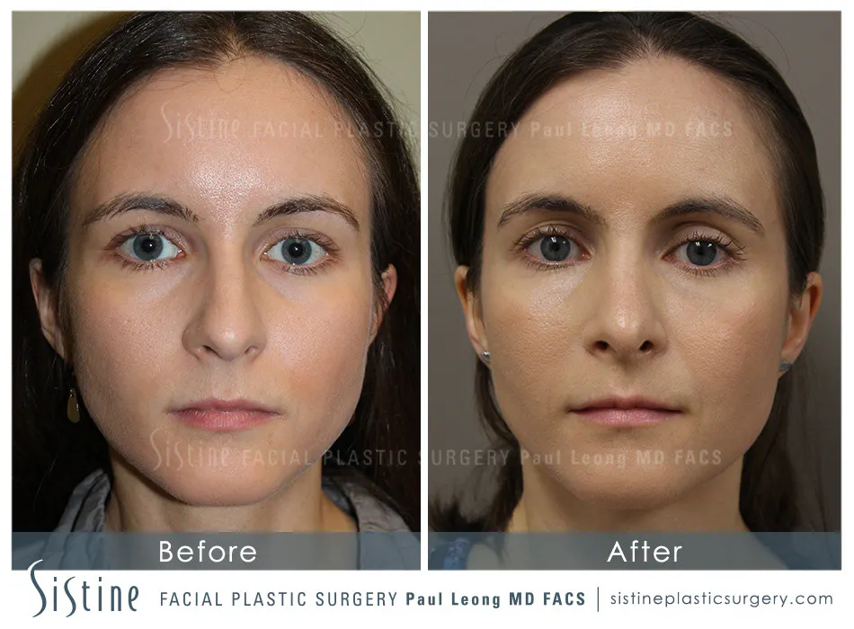Rhinoplasty Before and After | Leong Facial Plastic Surgery