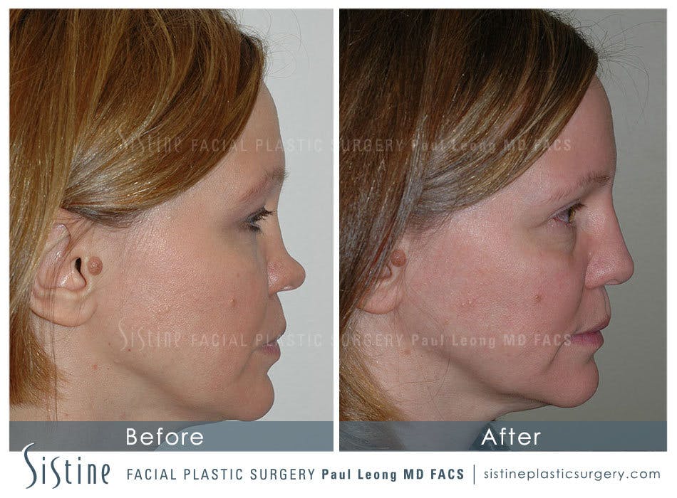 Rhinoplasty Before and After | Leong Facial Plastic Surgery