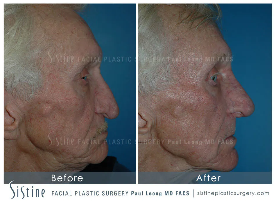 Will Rhinoplasty Help My Breathing - Patient Preopeartive View | Dr. Paul Leong, Pittsburgh PA