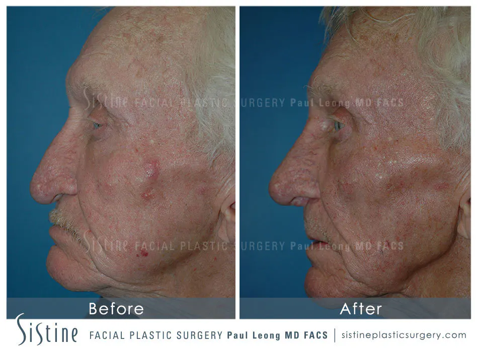Nose Changes With Age - Preoperative View | Dr. Paul Leong