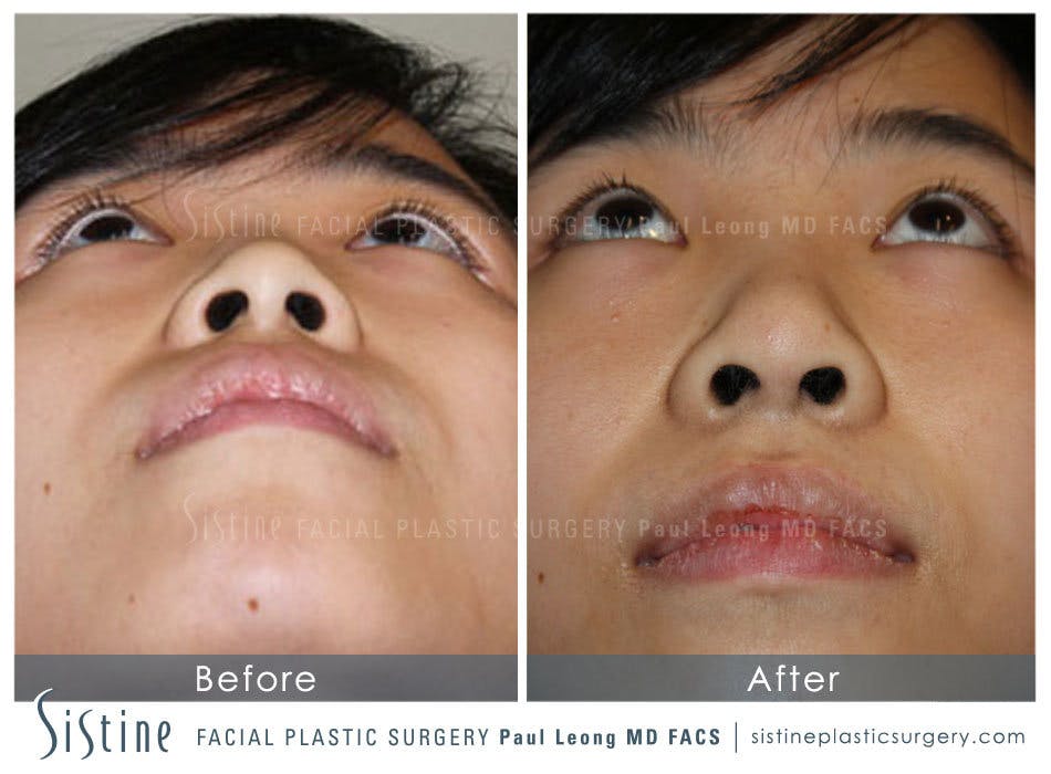 Rhinoplasty Before and After | Leong Facial Plastic Surgery