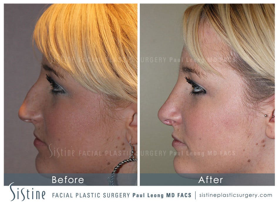 Rhinoplasty Before and After | Leong Facial Plastic Surgery