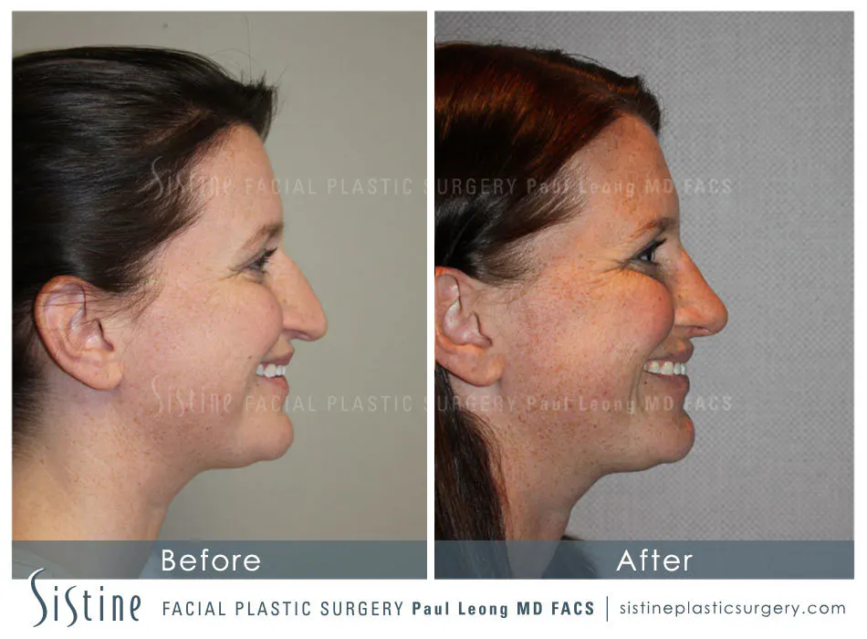 Highland Park Pittsburgh Rhinoplasty Surgery | Preoperative View | Dr. Paul Leong 