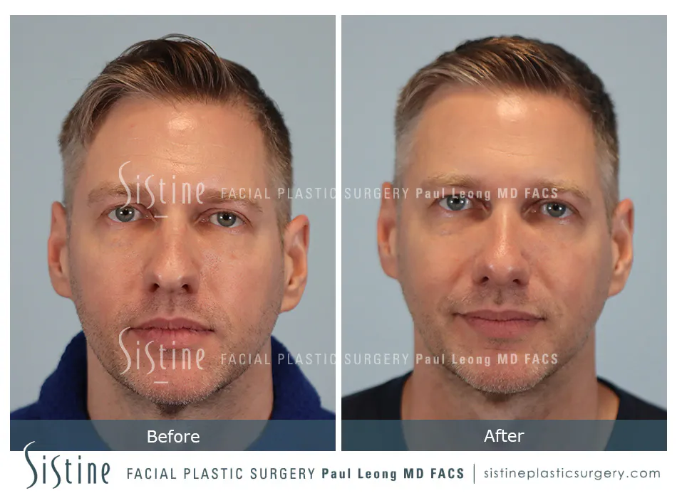 Rhinoplasty Before and After | Leong Facial Plastic Surgery