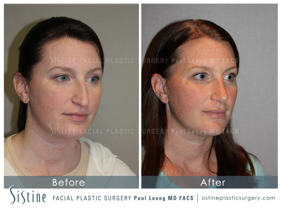 Rhinoplasty Before and After | Leong Facial Plastic Surgery