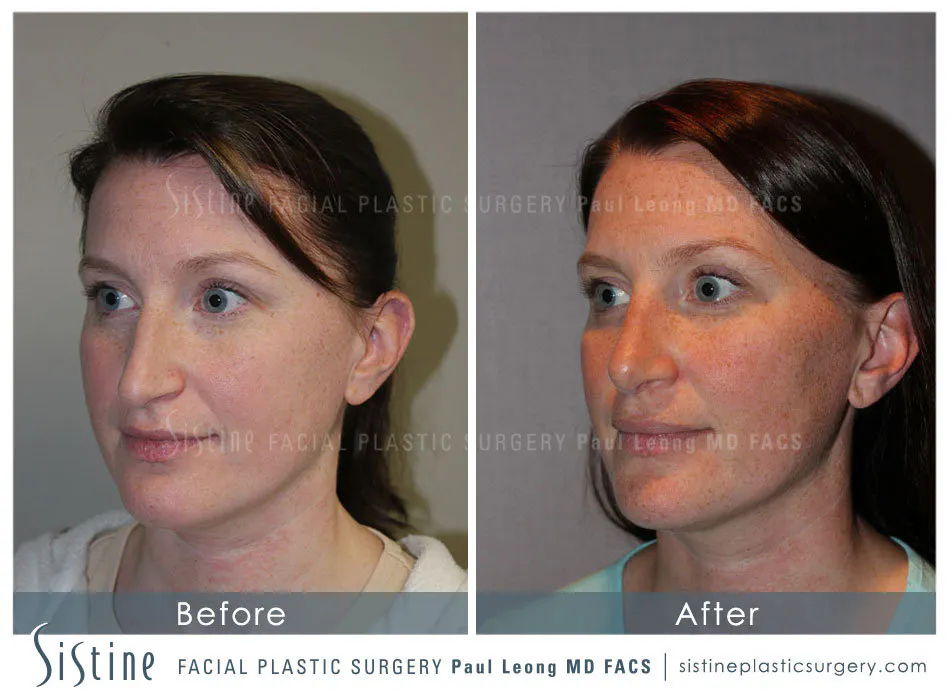 Rhinoplasty Before and After | Leong Facial Plastic Surgery