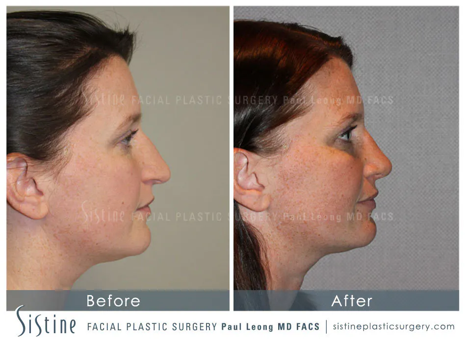 Rhinoplasty Before and After | Leong Facial Plastic Surgery