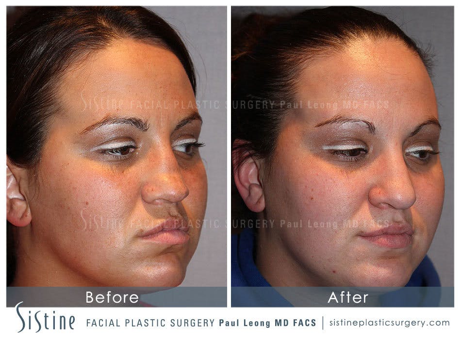 Rhinoplasty Before and After | Leong Facial Plastic Surgery